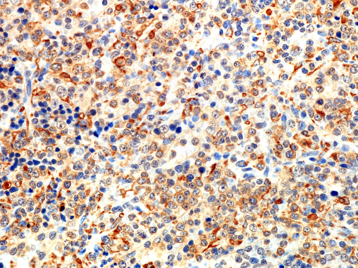 Spleen: MPO variably positive in blasts and myeloid cells 
